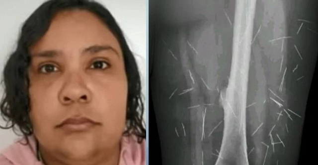 Golpista de 42 anos se passa por criança e é presa com 200 agulhas espalhadas pelo corpo