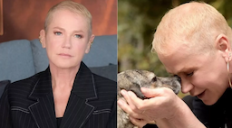 Xuxa Meneghel realiza implante capilar e fala sobre queda de cabelo