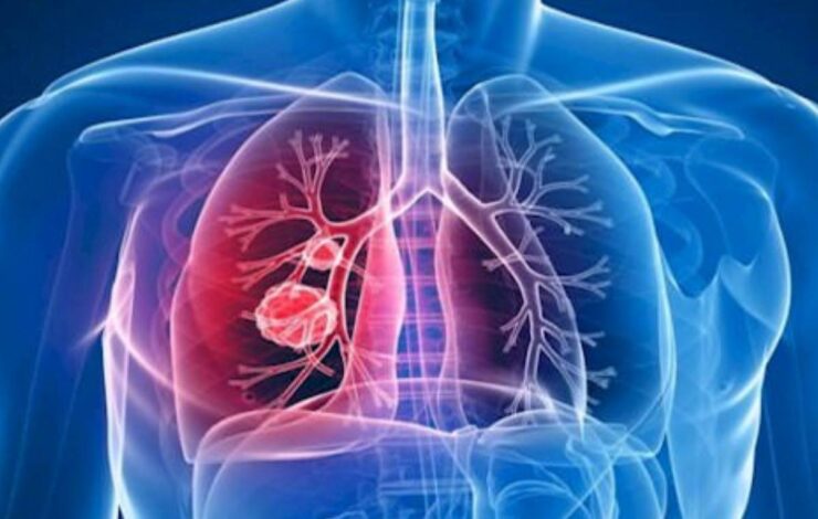 Dia Mundial da Tuberculose: Redes de tratamento precisam de mais investimentos, aponta especialista