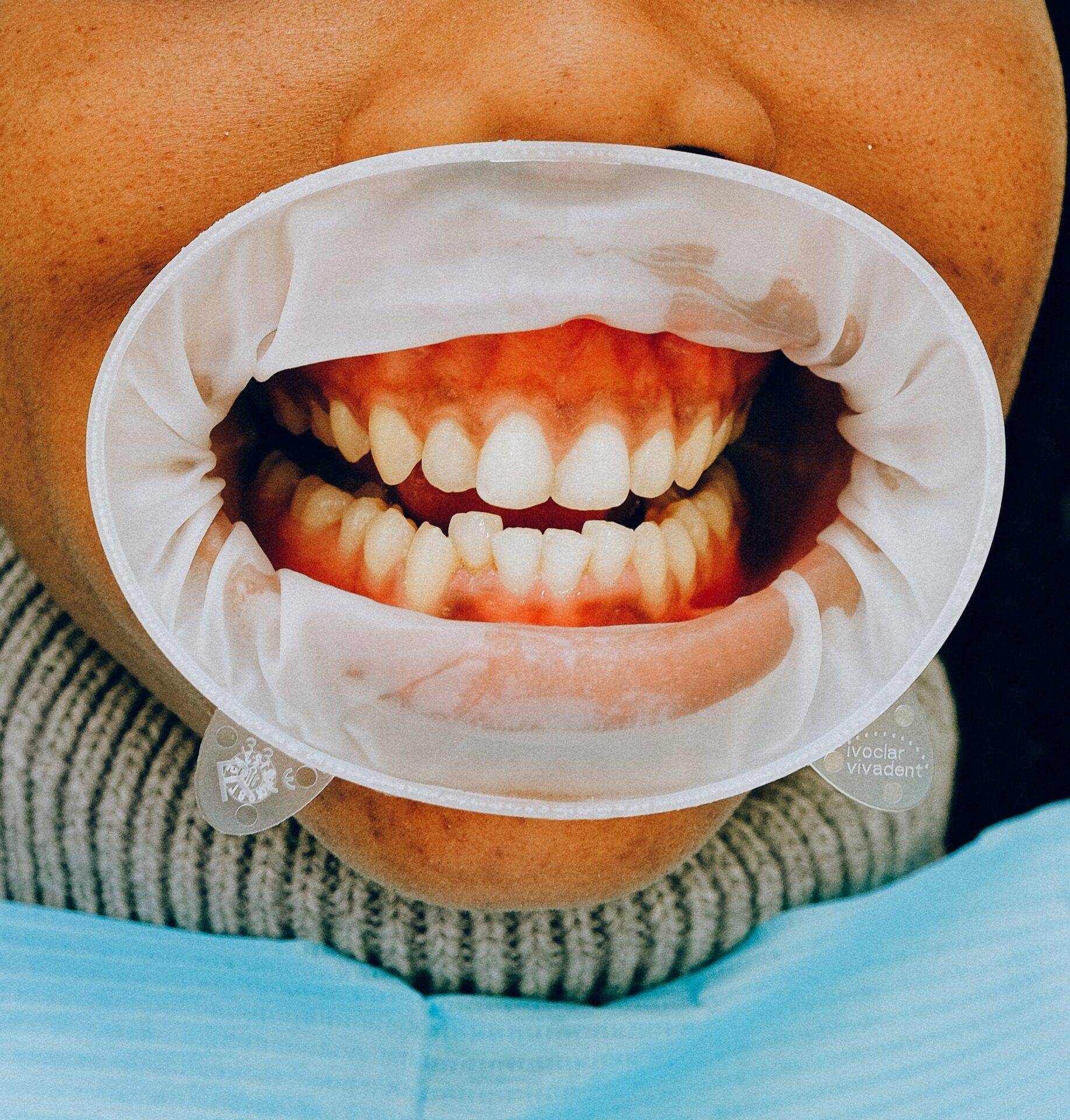 Sangramento na gengiva pode levar à perda dos dentes?