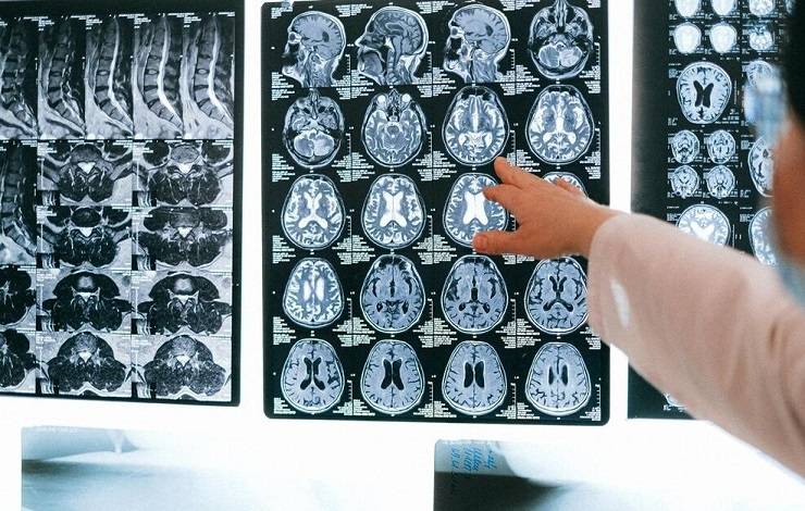 Meningite bacteriana faz 47 vítimas fatais no primeiro semestre de 2023, na Bahia