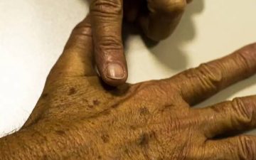 Dezembro Laranja: mutirão vai disponibilizar 700 atendimentos em prevenção contra o câncer de pele
